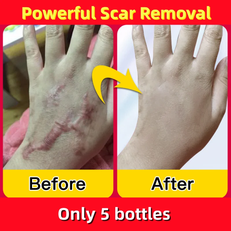 

Scar Recovery Cream Fast Scar Removal Gel Treat Surgery Scars Stretch Marks Acne Pits Pockmarks Burn Repair Skin Smooth Beauty