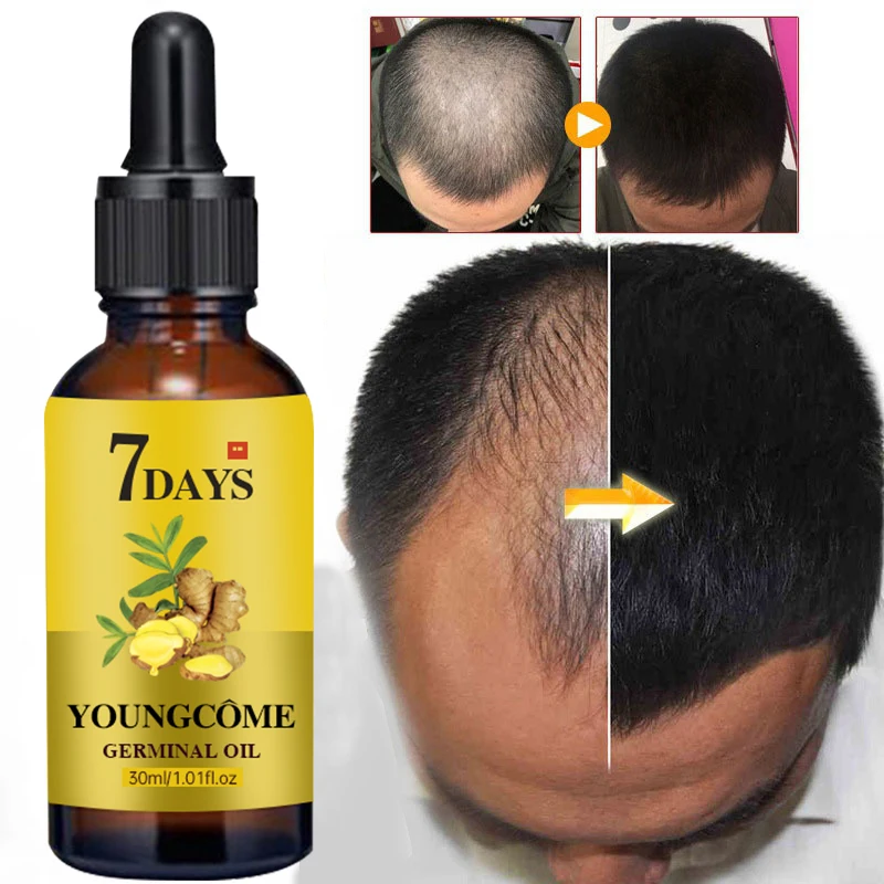 

Продукты для роста волос имбирное быстрорастущее эфирное масло для волос красота уход за волосами Предотвращение выпадения волос масло дл...