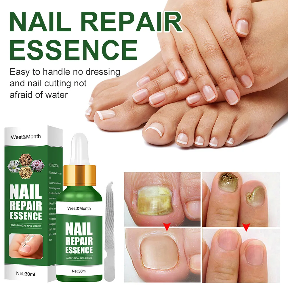 

30ml Fungal Nail Toenail Repair Essence Anti Infection Nail Fungus Removal Serum for Cracked Discolored Brittle Foot Nail Care