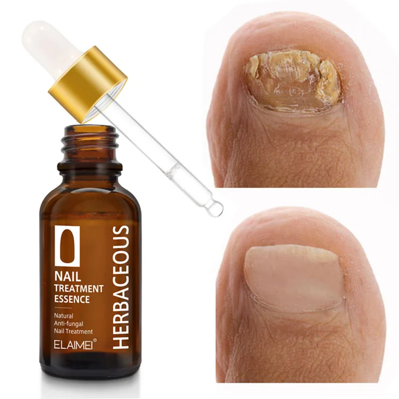 

Nails Fungal Treatment Serum Remove Paronychia Onychomycosis Foot Toe Fungus Cuticle Gel Anti Infection Beauty Health Nail Care