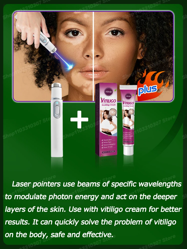 Blu-Ray Pen Vitiligo быстро улучшает белые пятна