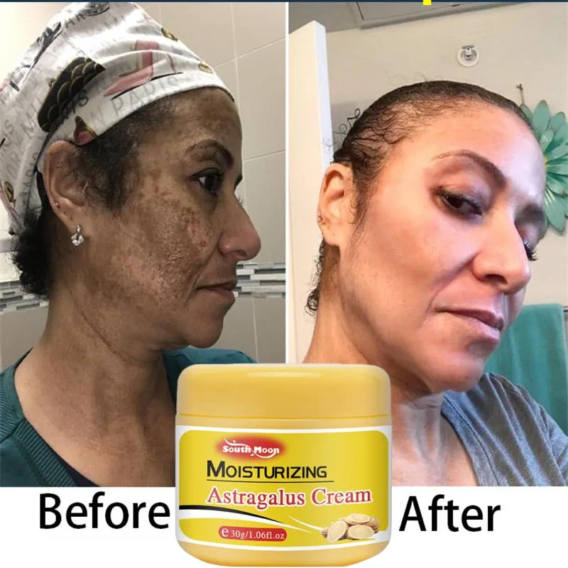 

Effective Whitening Freckle Cream Remove Acne Dark Spot Melanin Fade Melasma Anti-Pigmentation Improve Dullness Brighten Skin