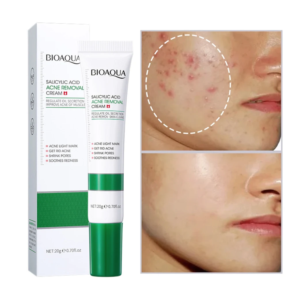 

Acido Salicilico Glicolico Espinhas Pimple Acne Scar Pigmentation Removal Cream For Face Dark Spots Serum Cremas Faciales Kremy