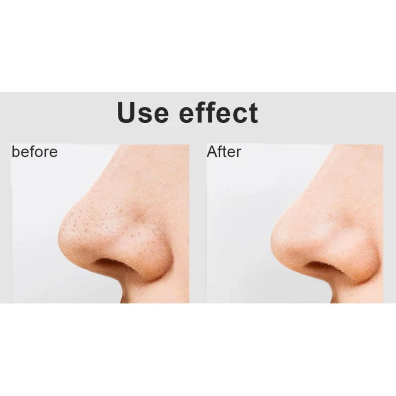 Средство для удаления черных точек на лице глубокий очиститель носа устройство