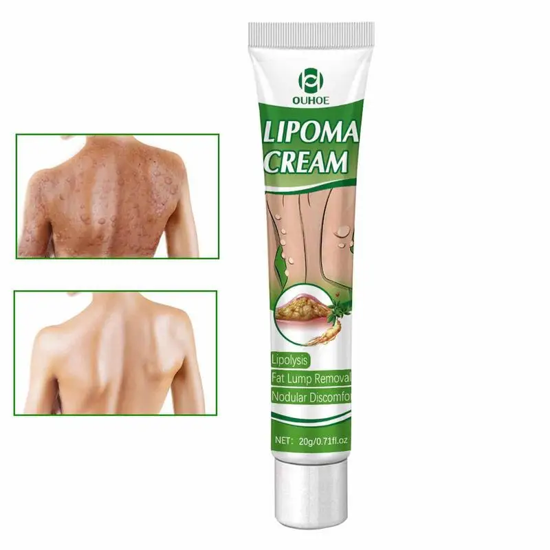 

Lipoma Lumps Removal Cream Lipoma Removal Ointment Stop Fatty Lumps Get Rid Of Your Fatty Lipoma Lumps Used For Whole Body