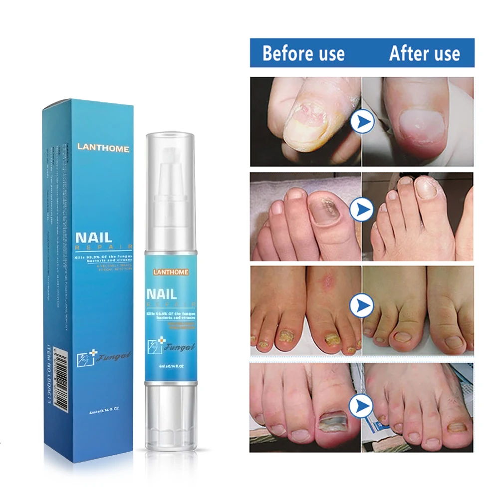 

Fungal Nail Treatment Pen Onychomycosis Paronychia Anti-Fungal Serum Nail Infection Toe Fungus Foot Repair Essence Care
