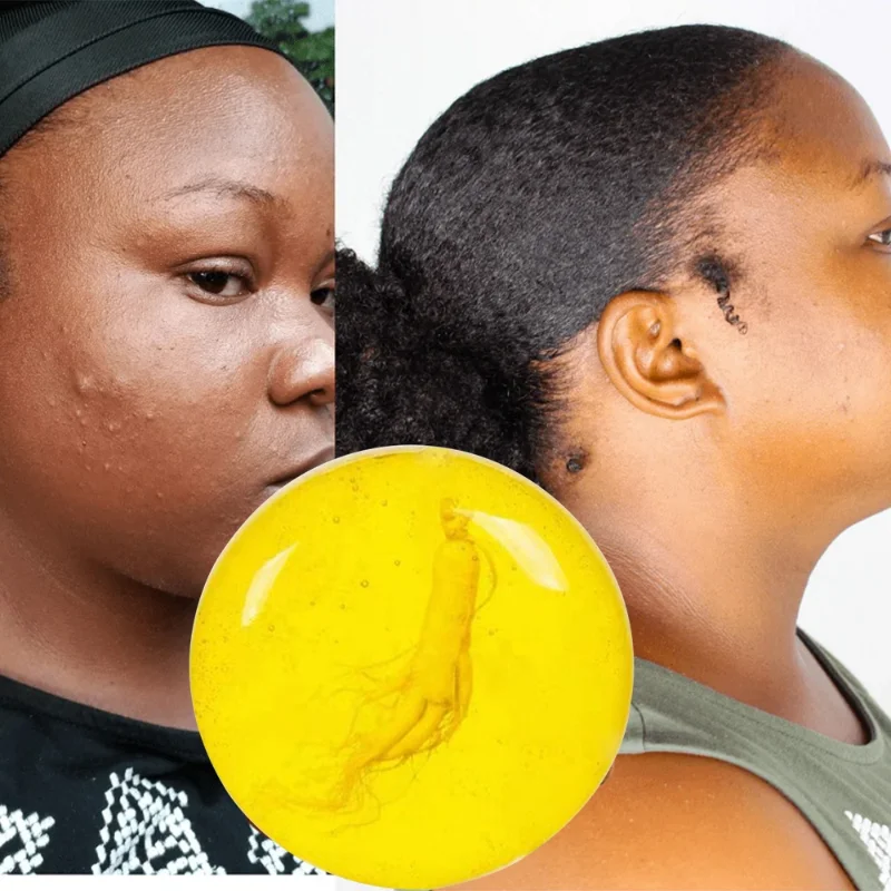 Добавьте акне прыщи пятна шрамы корректор темных пятен афроамериканское мыло