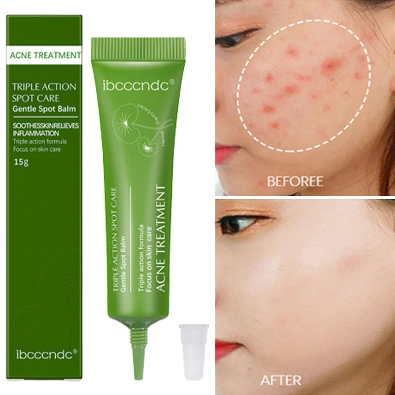 

Herbal Acne Removal Cream For Face Salicylic Acid Pimple Cleaner Repair Scar Shrink Pore Treatment Oil Control Moisturizing Skin