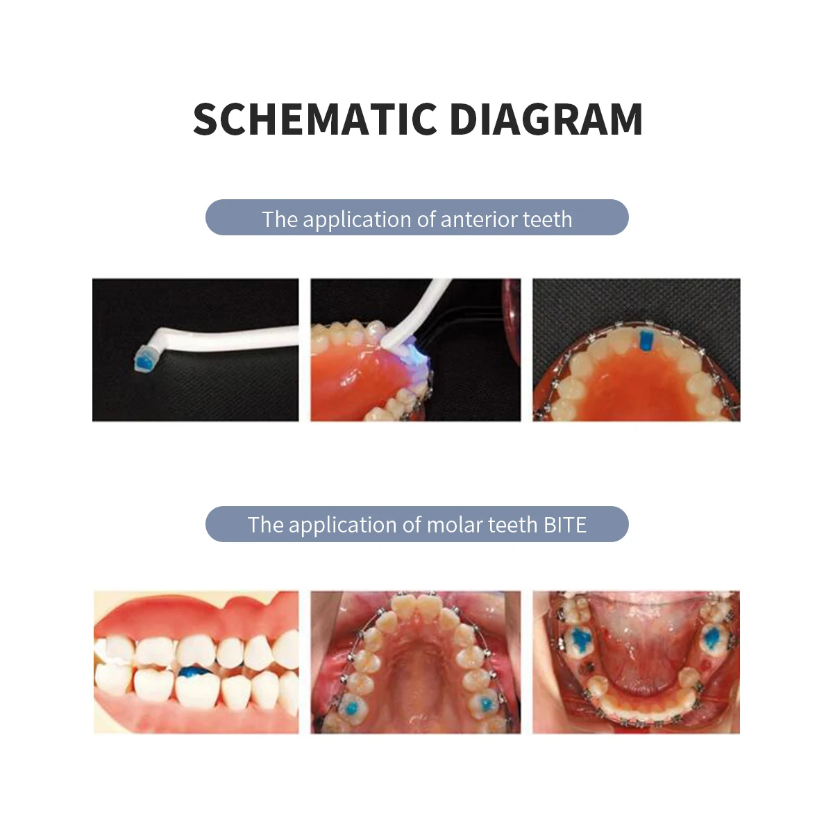 Набор стоматологических светоотверждаемых клеев ортодонтический материал для