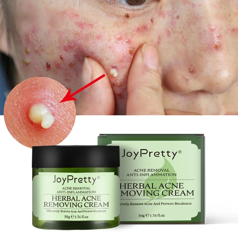 

50g Joy Pretty Herbal Day Cream For Acne Skin Care Face Moisturizer Oil Control Pimple Acne Removal Cream Korean Cosmetics