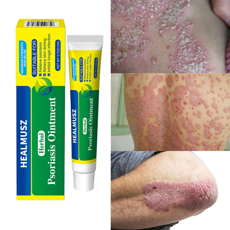 

20gAntibacterial Psoriasis Cream Herbal Effective Anti-itch Relief Dermatitis Eczema Treatment Urticaria Desquamation Skin Care