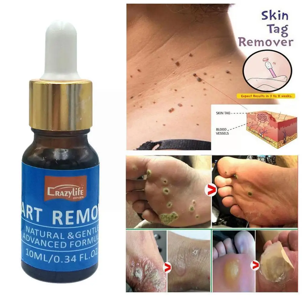 

10ml Body Wart Treatment Papillomas Removal Of Warts Tags Removing Remover Verruca Skin Liquid Moles Anti Remedy From M2f6