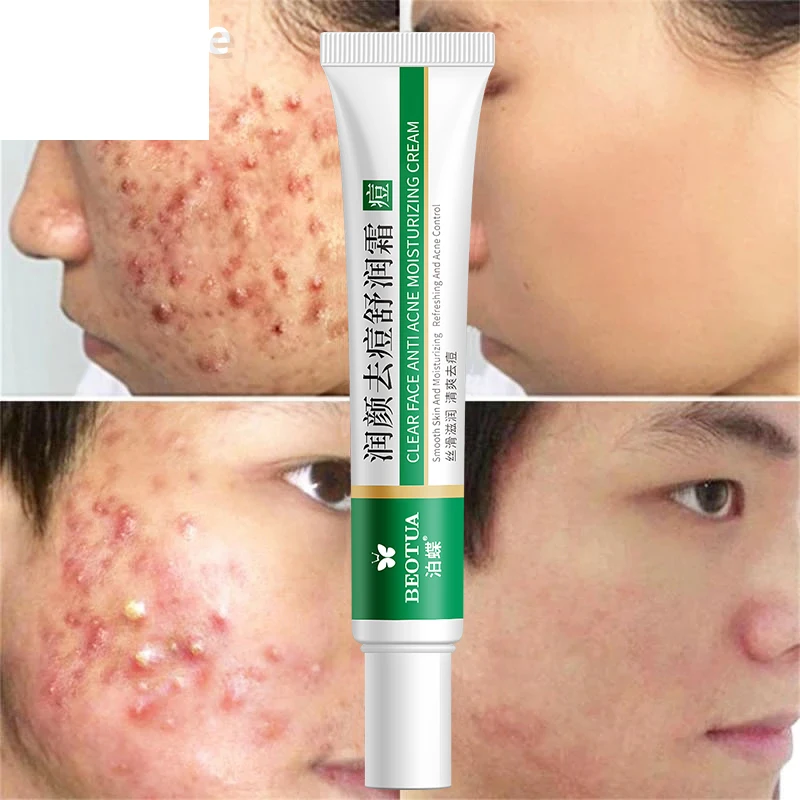 

Эффективное средство для удаления акне, освежающее пятна от акне, крем от акне, отбеливающий увлажняющий гель для лица, уход за кожей 20 г