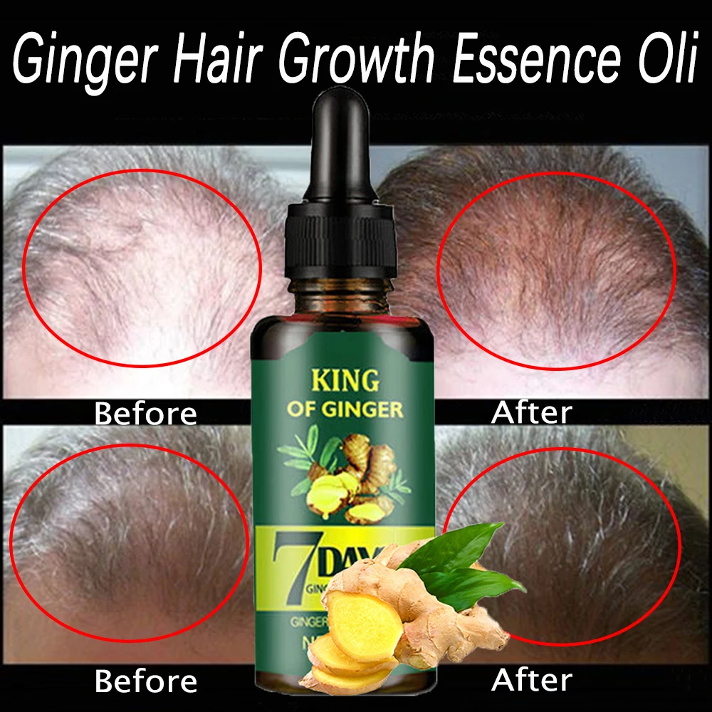

Эссенция для быстрого роста волос Ginger, сыворотка против выпадения волос, питает кожу головы, продукты для роста волос для мужчин и женщин, во...