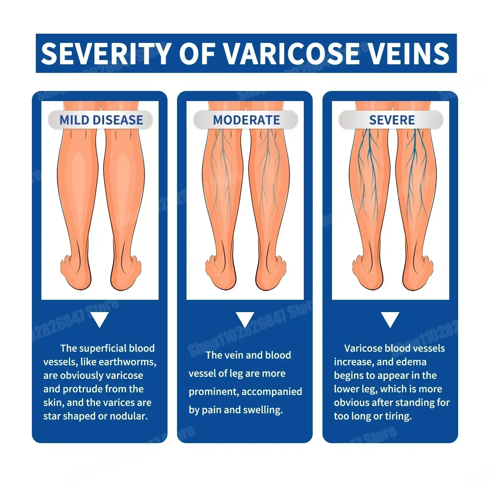 Надежный спрей для варикозного расширения вен натуральные травы успокаивающий с