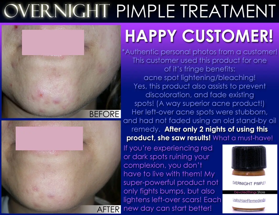 

HERBAL OVERNIGHT SPOT TREATMENT for BLEMISHES PIMPLES ACNE CYSTS and BOILS