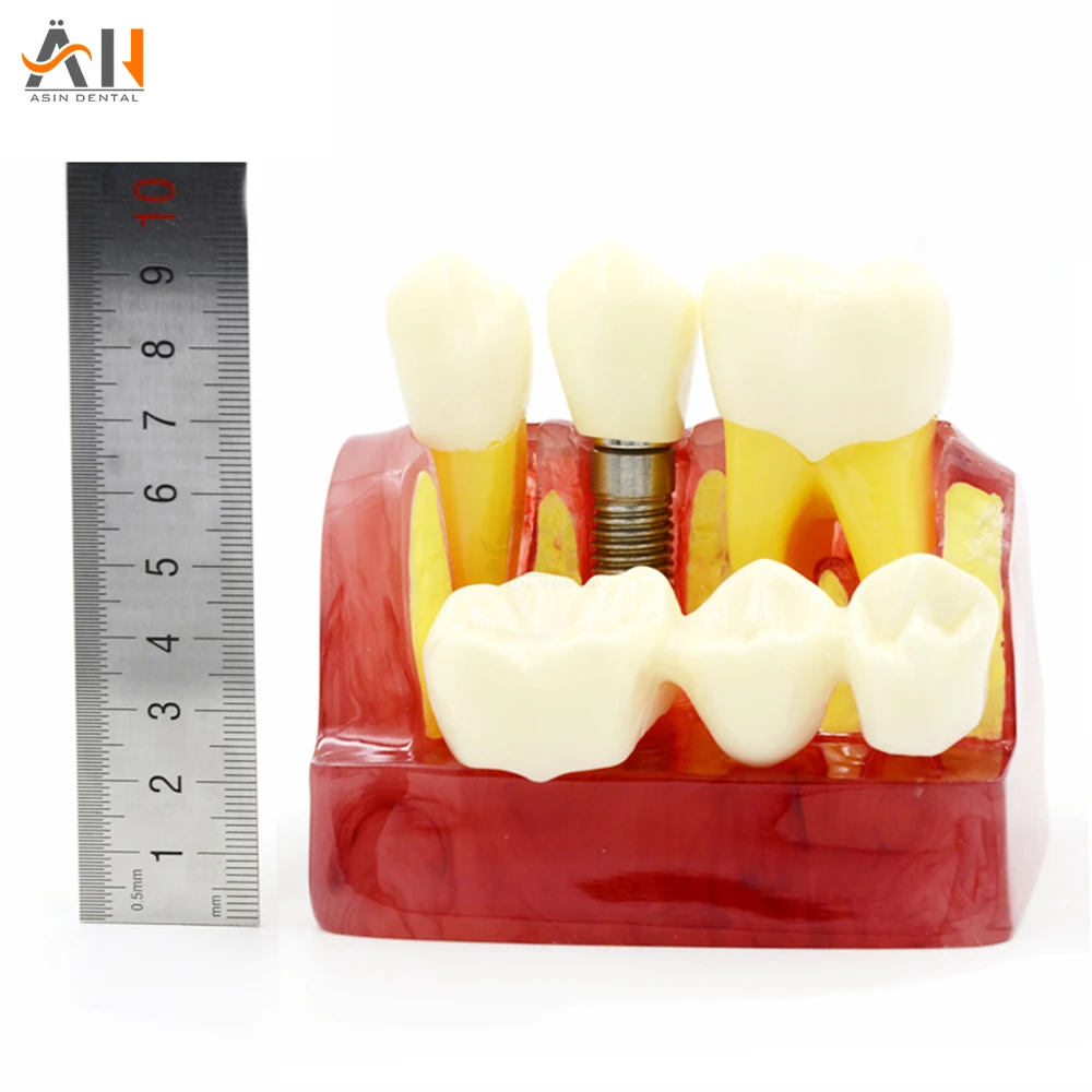 

Стоматологическая модель имплантата Deasin, патологическое Восстановление зубов, мост для коррекции зубов, обучение, медицина