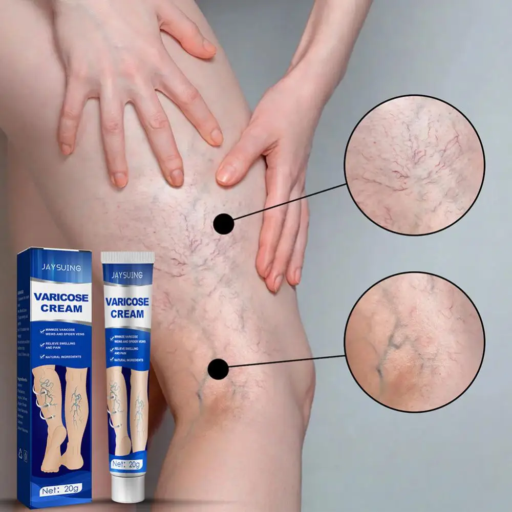 

20g Varicose Veins Spray Varicosity Repair Cream Varicocele Remove Relief Pain Phlebitis Legs Varicose Veins Skin Care