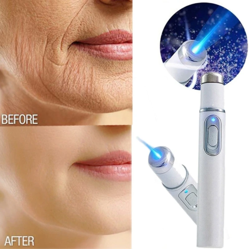 

Acne Wrinkle Removal Laser Pen Skin Spots Removal Anti Varicose Spider Vein Eraser Treatment Portable Medical Blue Light Therapy
