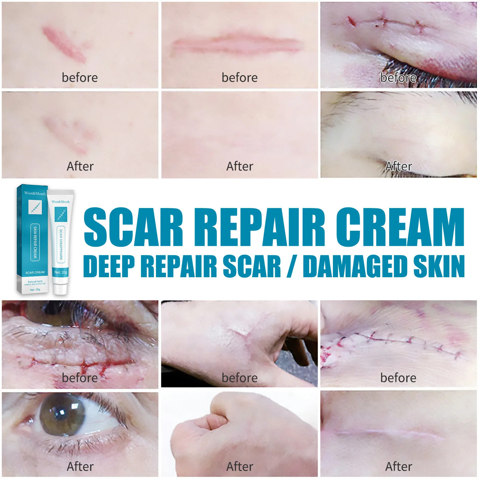 Крем травяной для удаления шрамов от растяжек Устранение пятен акне лечение