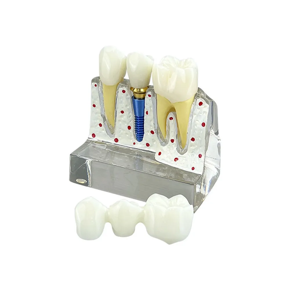 Тренировочная модель для зубного импланта 4-кратный анализ имплантов коронного