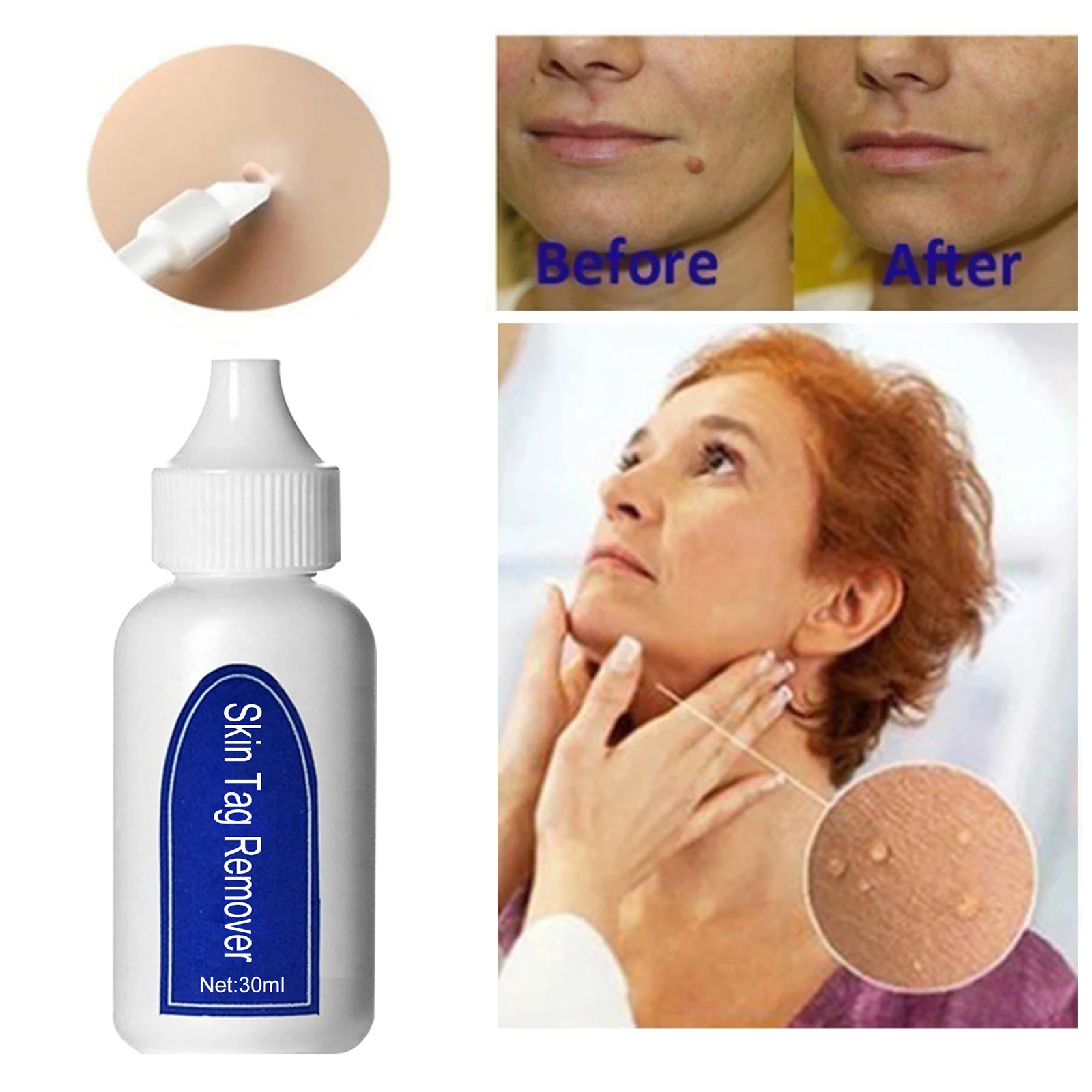 

30ml Skin Tag Remover Liquid Wart Removal Freckle Wart Dark Spot Remover Wart Body Tag Freckle Skin Care Liquid