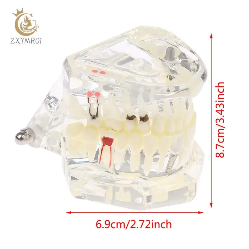 

Dental Model Teeth Implant Restoration Bridge Teaching for Study Tooth Science