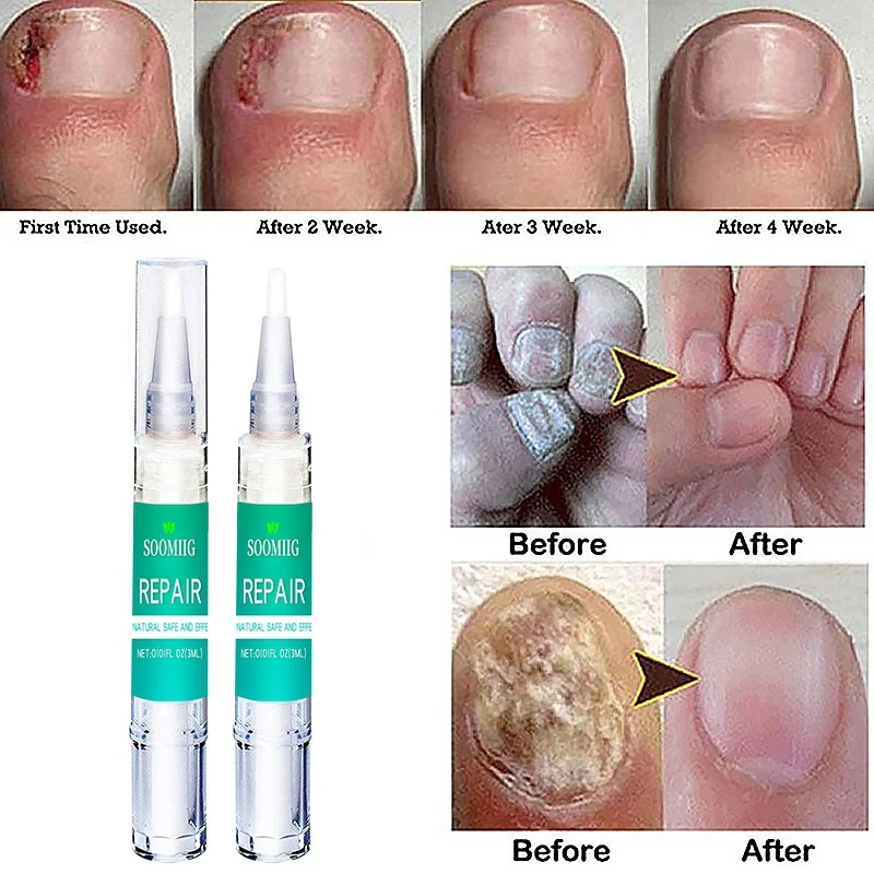 

3ml Nail Nutrition Pen Antifungal Nail Repair Solution Bright Nail Bio Protective Film Nail Care Pen