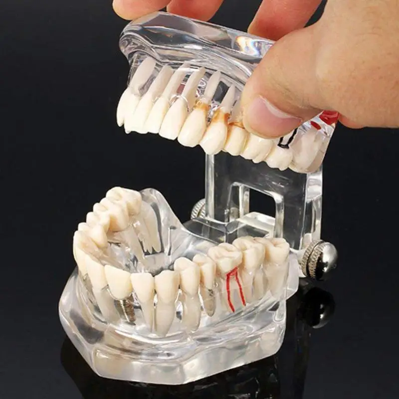 

Dental model transparent removable dental implant model with bridge pulp demonstration model