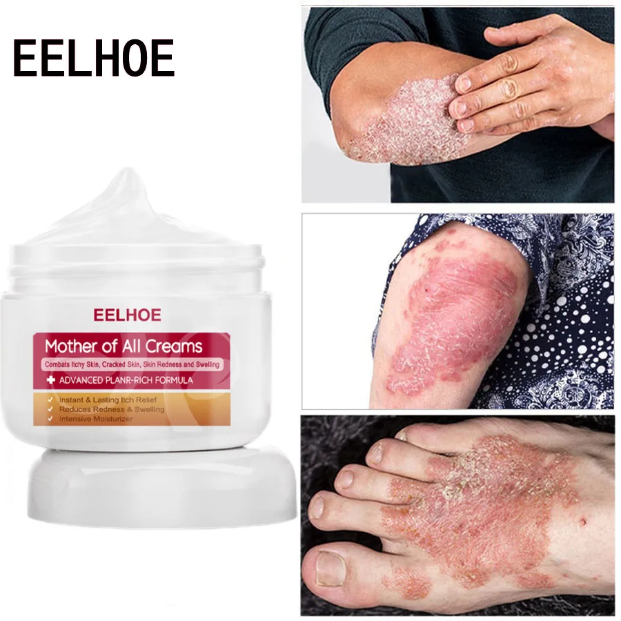 

50 г, травяной Антибактериальный крем для защиты от зуда