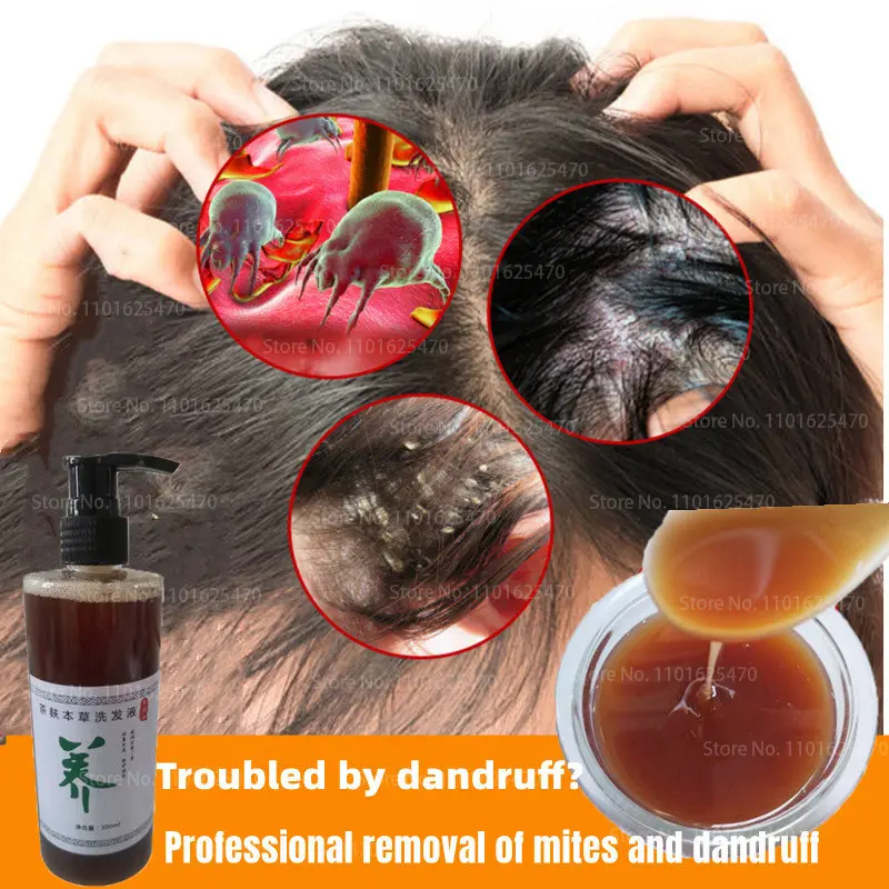 

African Hand-brewed Tea Bran Herbal Shampoo for Psoriasis, Seborrheic Dermatitis, Mites, Dandruff, Itching and Oil Control