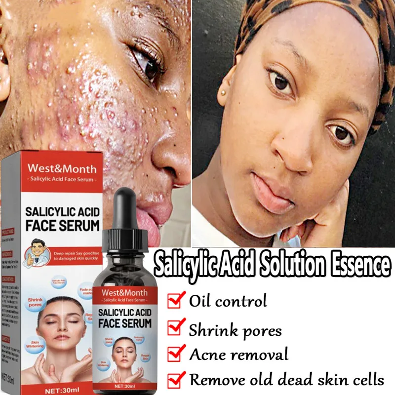 

Раствор салициловой кислоты, 30 мл, эссенция для сокращения кожи, лечение акне, шрамов, отбеливание, увлажнение, масло для лица