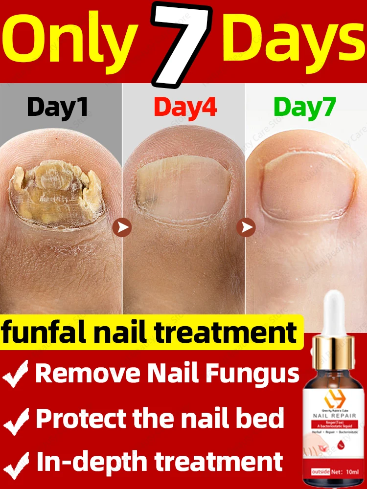 

Грибковые ногти Уход восстановление Fast Onychomycosis Nails