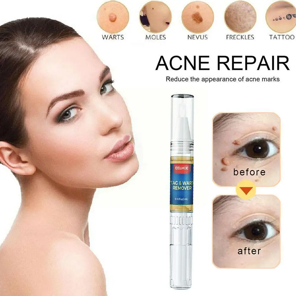 

Skin Beauty Mole Removal Pen Repair No Trace Beauty Of Liquid Pen Removal Mole Papilloma Treatment Warts Skin D2g7