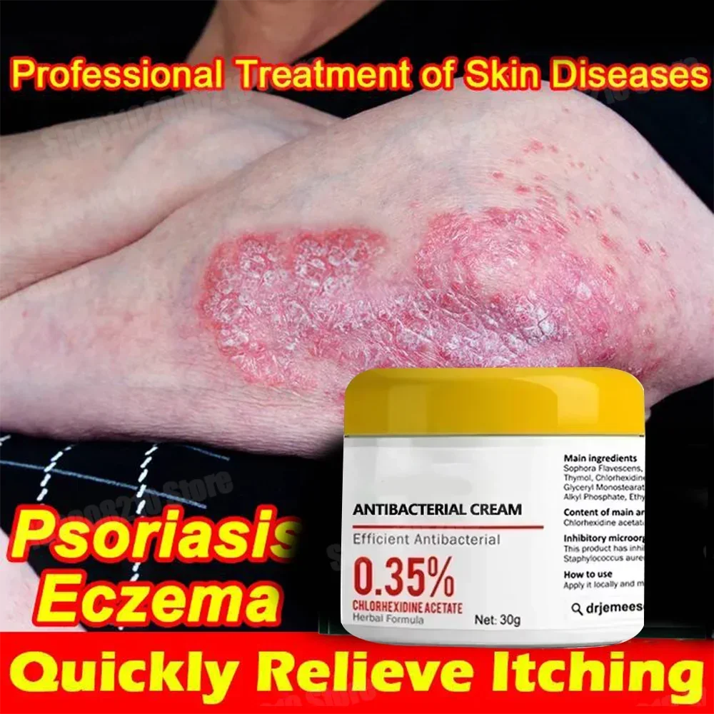 Psoriasis Eczema Effective Antibacterial Cream Treat Dermatitis Care Dressing Urticaria Unguent Anti-itch Products