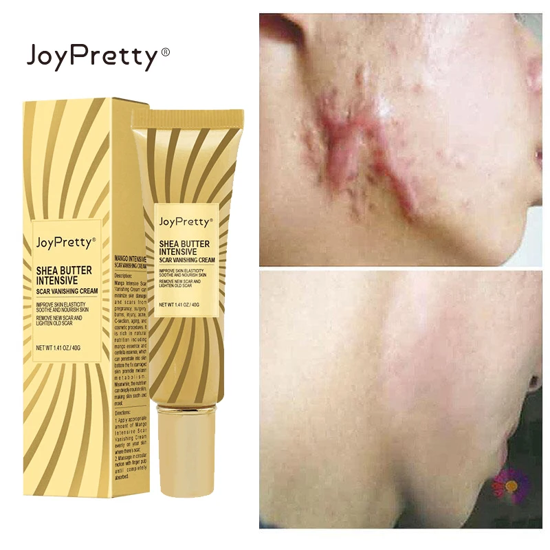 

Herbal Scar Repair Cream Pimples Stretch Marks Remove Gel Burn Surgical Scars Treatment Smooth Whitening Body Skin Care Products