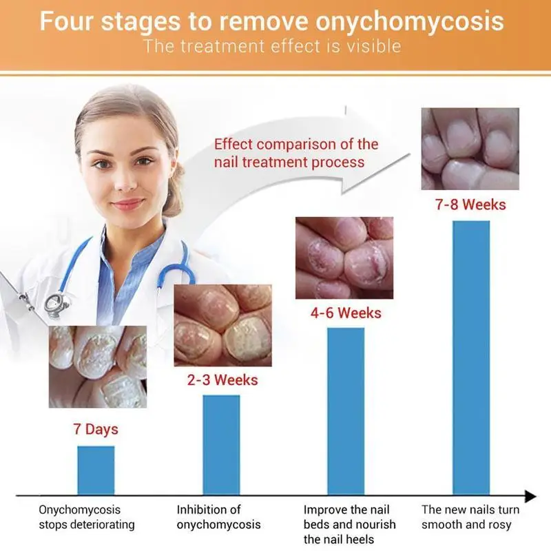 LANBENA Уход за грибком Удаление онихомикоза пальцев Питание ногтей Ноги Пепреры