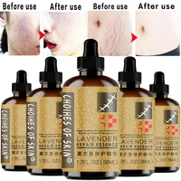 10ml50ml scar repair skin essential oil lavender essence skin care natural pure remove acne burn stretch marks scar removal