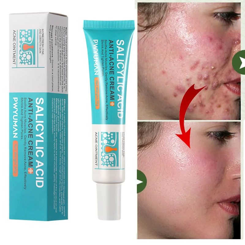 

Salicylic Acid Acne Removal Cream Effective Acne Treatment Repair Spots Scar Gel Oil Control Shrink Pore Moisturizing Skin Care