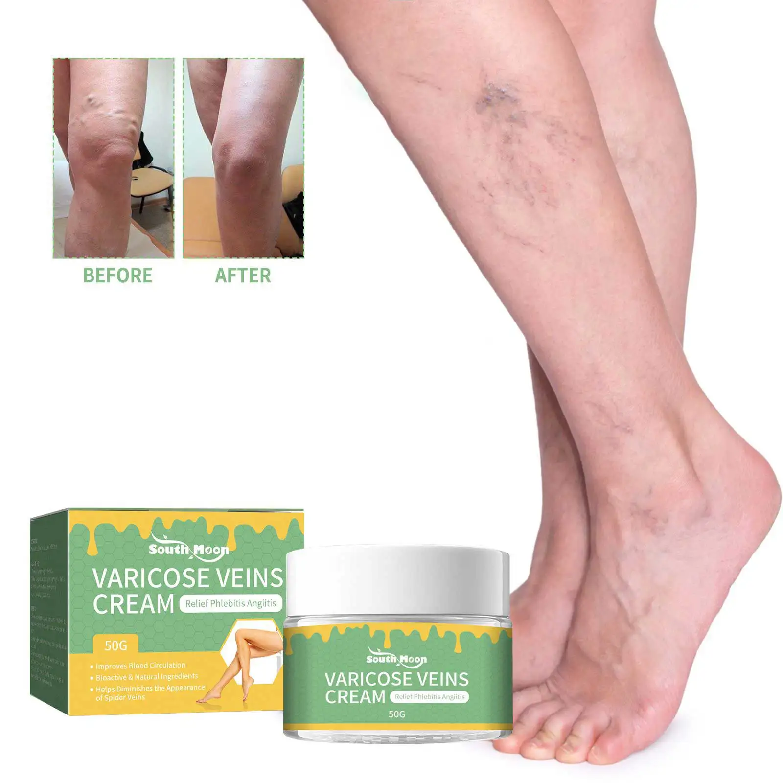 

Phlebitis Treatment Cream Relieve Vasculitis Earthworm Leg Treat Varicose Swelling Remove Leg Pain Spider Veins Relief Ointment