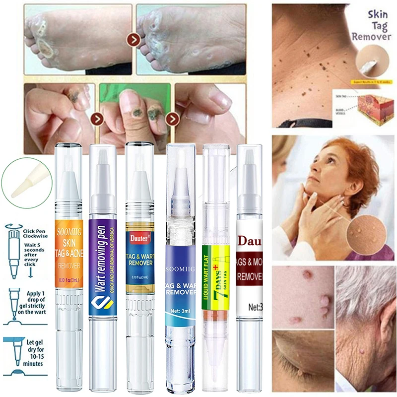 

Removing Against Moles Liquid Pen Treatment Papillomas Removal of Warts Liquid From Skin Tags Remover Anti Verruca Remedy