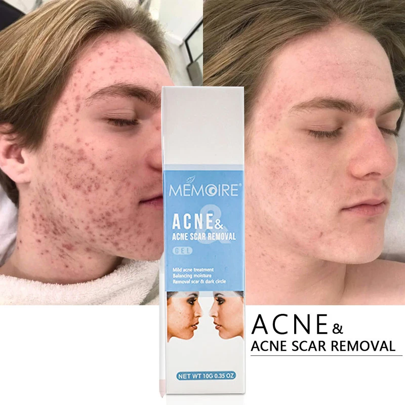 С травами против акне крем для отбеливания удаления шрамы от устраняют прыщи