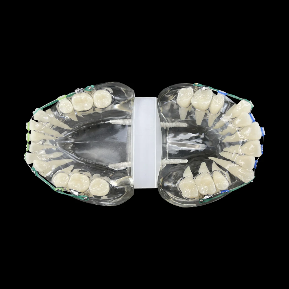 Ортодонтическая модель зубов с металлическими и керамическими звеньями