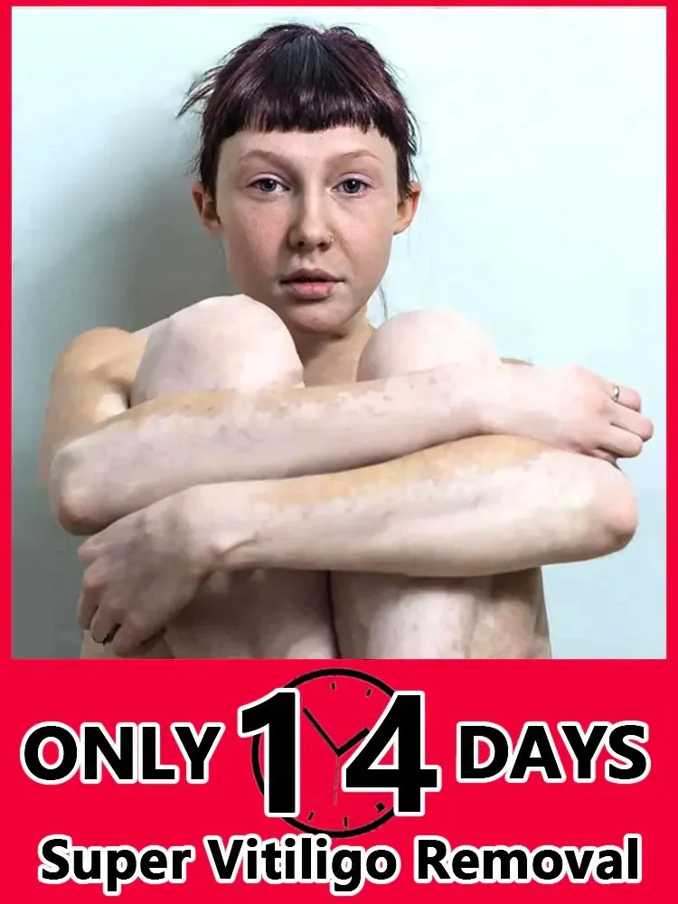 Крем для ухода за волосами Vitiligo смягчающая мазь удаления белых пятен устранение