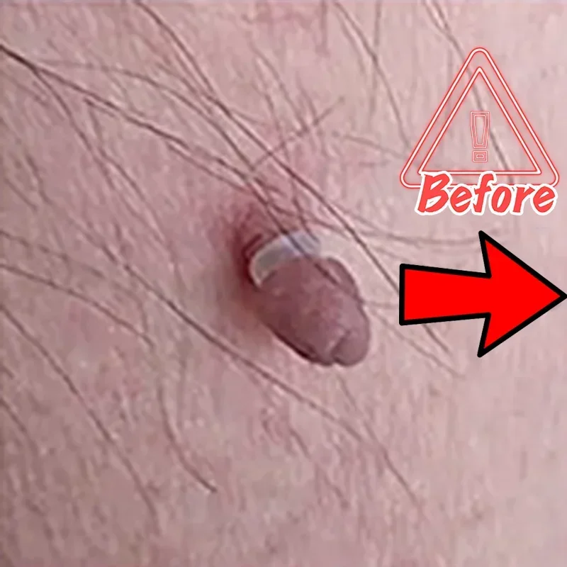 Морской невус на голове бородавки кожу головы обезьяне каулифтовая ручка