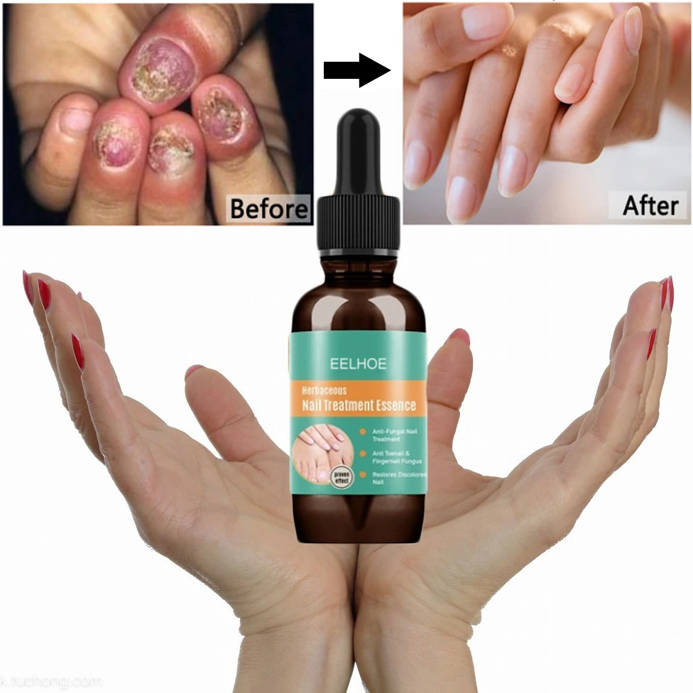 

3DAYS Fungal Nail Treatment Serum Foot Ringworm Repair Essence Care Whitening Toe Nail Fungus Removal Gel Anti Infection 10ml