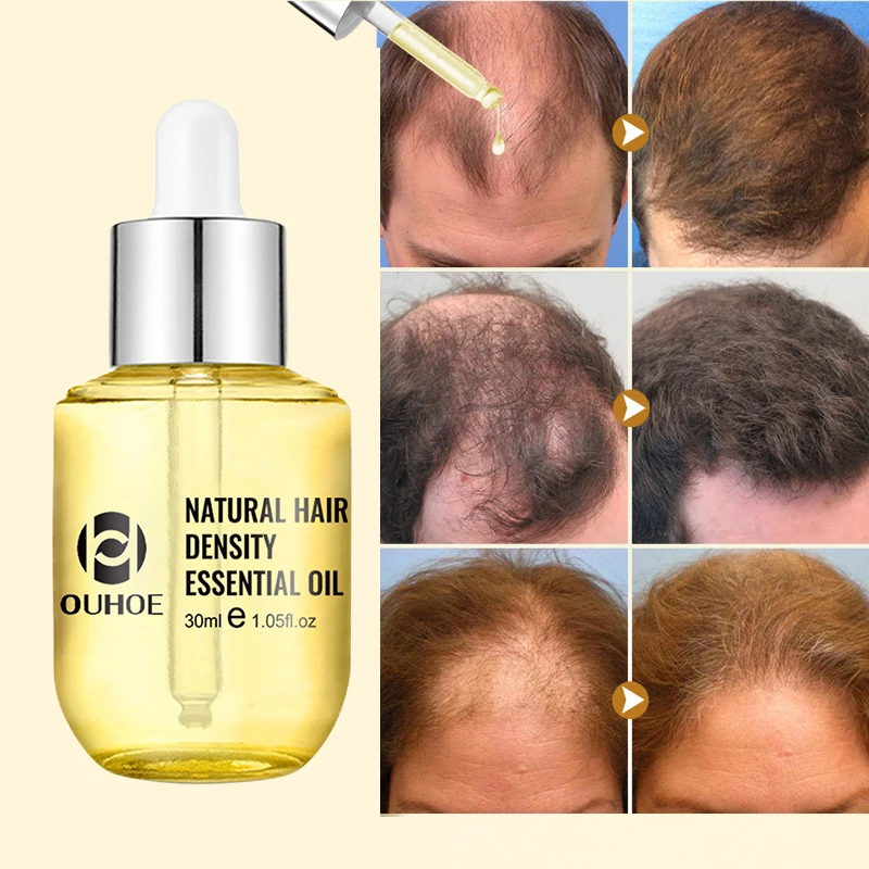 Fast Hair Growth Serum For Women Men Baldness Hair Loss Treatment Essential Oils Beard Hair Growth Thickening Products Care 30ml