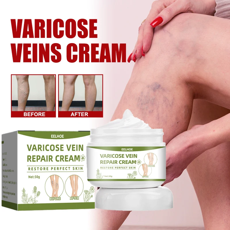 

Varicose veins ointment through vein leg relief cream relieve vasculitis phlebitis spider bulge pain Massage treatment repair