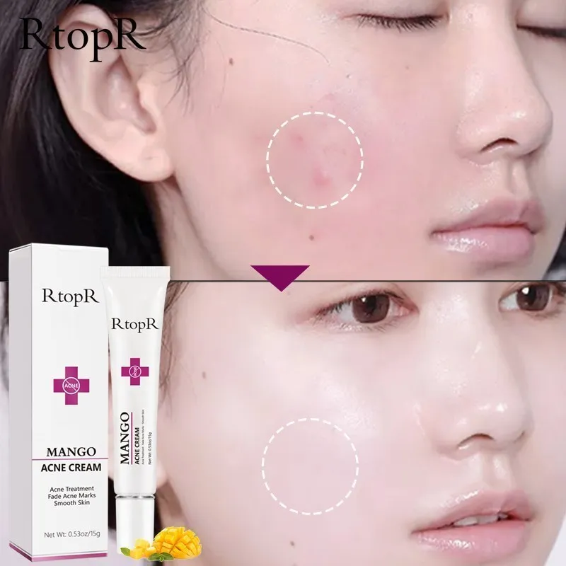 

Acne Treatment Face Cream Blackhead Repair Oil Control Shrink Pores Scar Moisturizer Skin Care Korean Cosmetics Whitening Creams