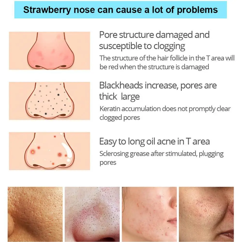 Средство для удаления черных точек 30 мл